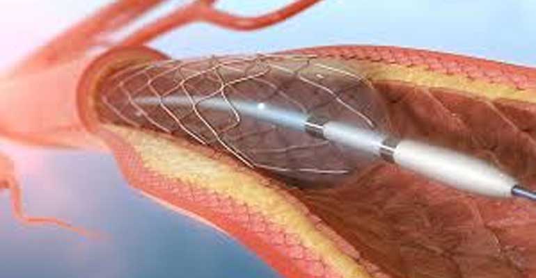 Best Heart Care Centre for Angioplasty in Kolhapur